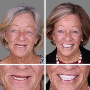 🔥Limited Time 50% OFF: 2nd ltem 60% Off🔥(Affordable Beauty🧏♀️🧏♂️)--Couriuay™ --Advanced Customized Full Denture Set🦷