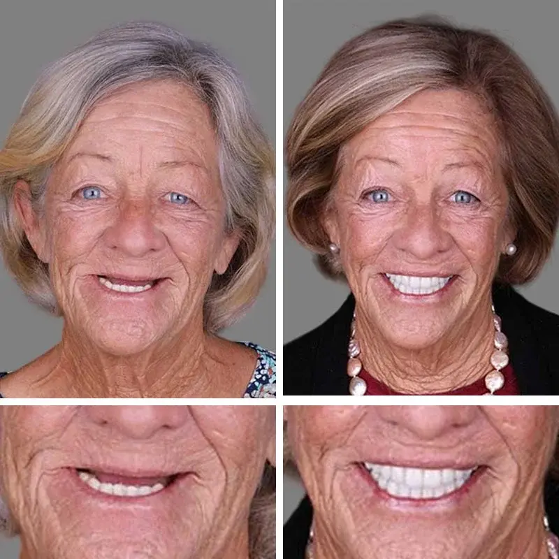 🔥Limited Time 50% OFF: 2nd ltem 60% Off🔥(Affordable Beauty🧏♀️🧏♂️)--Couriuay™ --Advanced Customized Full Denture Set🦷