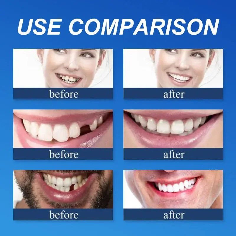 🔥Limited Time 50% OFF: 2nd ltem 60% Off🔥(Affordable Beauty🧏♀️🧏♂️)--Couriuay™ --Advanced Customized Full Denture Set🦷