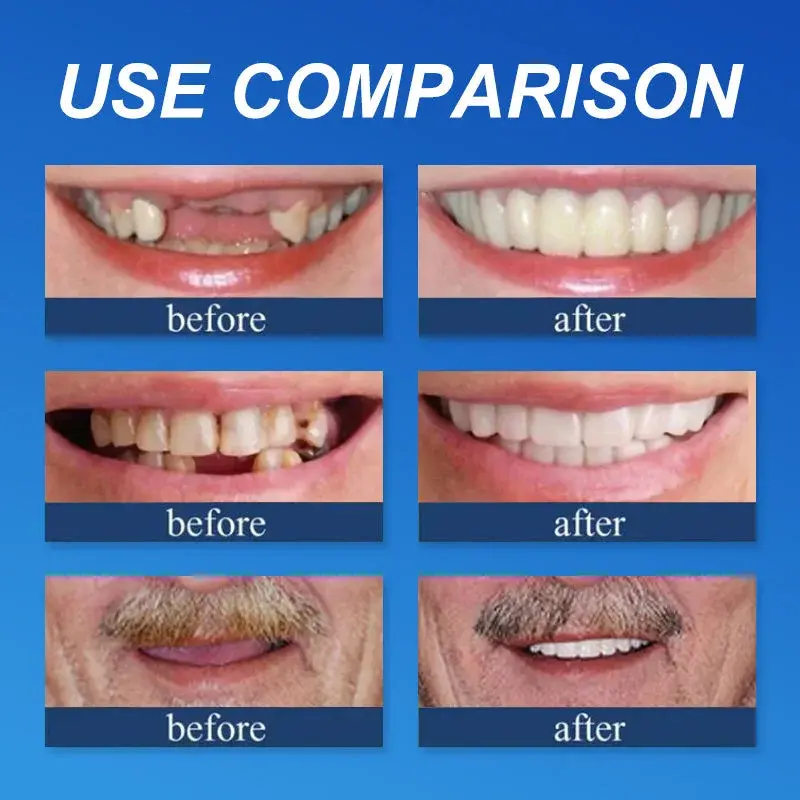 🔥Limited Time 50% OFF: 2nd ltem 60% Off🔥(Affordable Beauty🧏♀️🧏♂️)--Couriuay™ --Advanced Customized Full Denture Set🦷