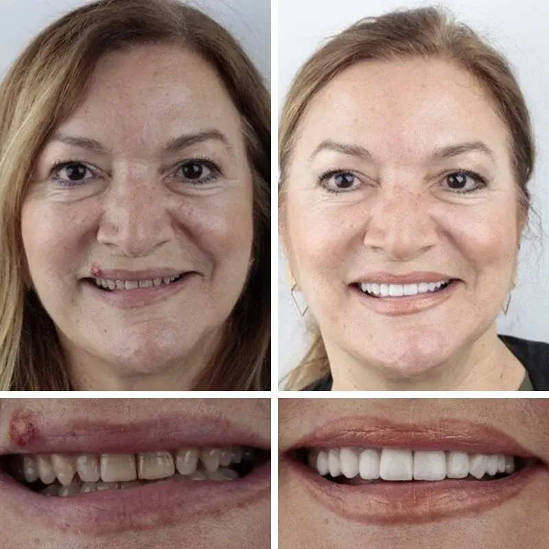 🔥Limited Time 50% OFF: 2nd ltem 60% Off🔥(Affordable Beauty🧏♀️🧏♂️)--Couriuay™ --Advanced Customized Full Denture Set🦷